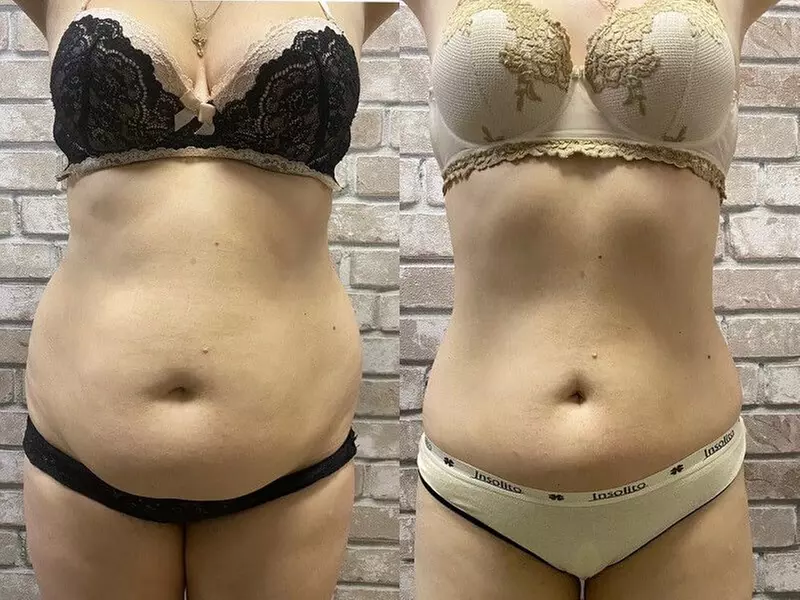 Transform with Next-Generation 10D & Advanced Laser Lipo Treatments