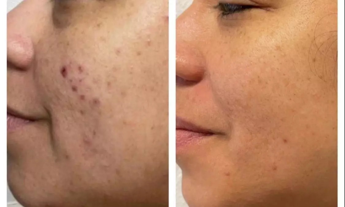 Up to 60% Off on Injection - Plasma at Beauty_Lash_LLC - Second Medium