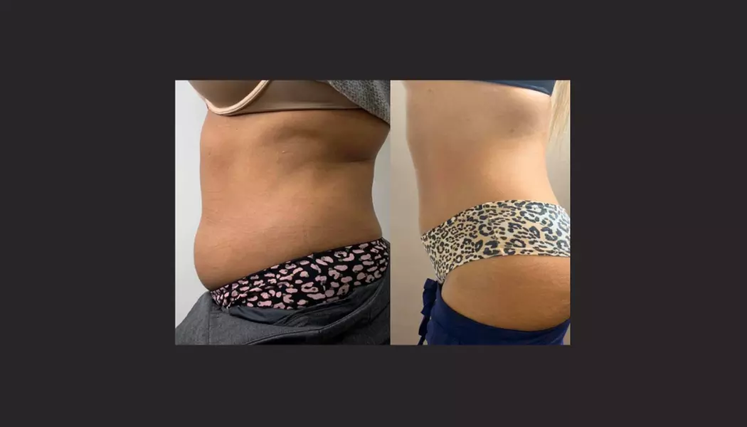 Up to 79% Off on Fat Reduction - Non-Branded at MOI-MODERN OUTPATIENT IMAGE - Primary Image