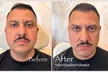 Sculpt Your Jawline with Logica Aesthetics' Juvederm Ultra/Volux XC (Up to 55% Off) - Second Medium