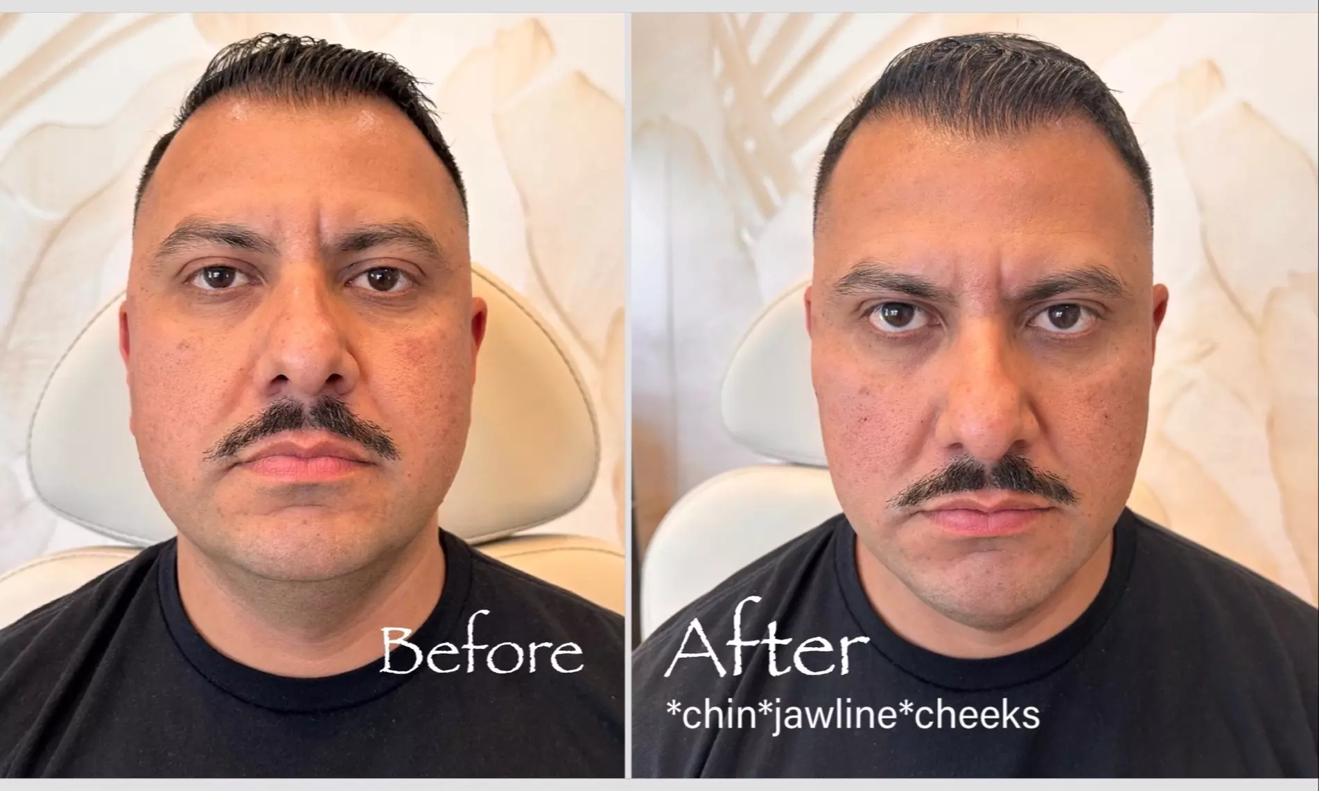 Transform Your Look: Juvederm Ultra/Volux XC for Jawline Contouring