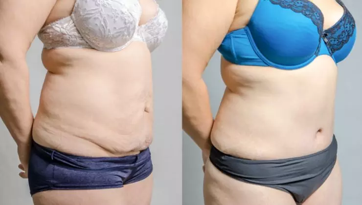Non-Invasive Laser Lipo Treatments for a Slimmer You