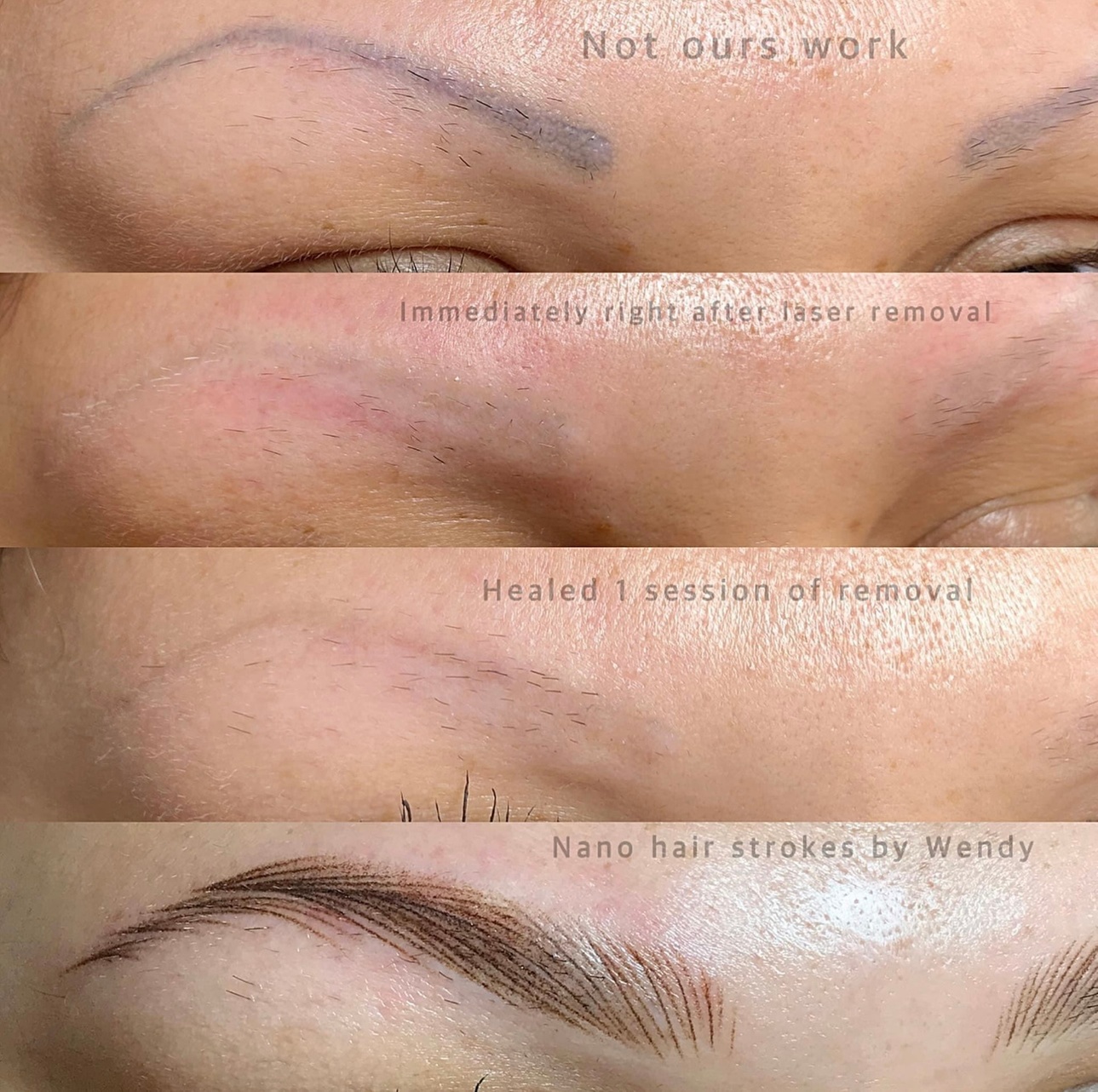 Laser Eyebrow Removal Treatments for Smooth Skin