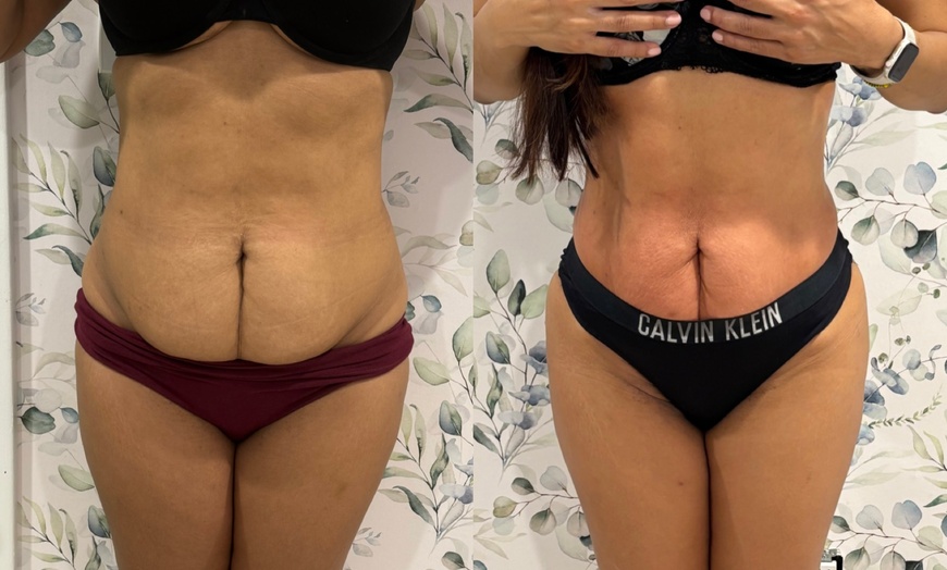 Image 2: Up to 69% Off on Cavitation at Soleil med spa