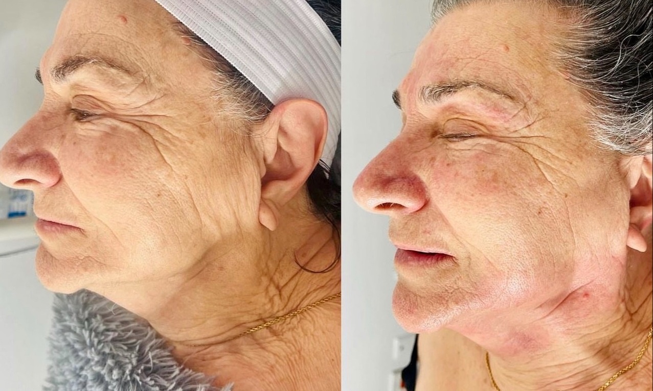 Up to 51% Off on Radio Frequency Skin Tightening at Sunflower Beauty Studio