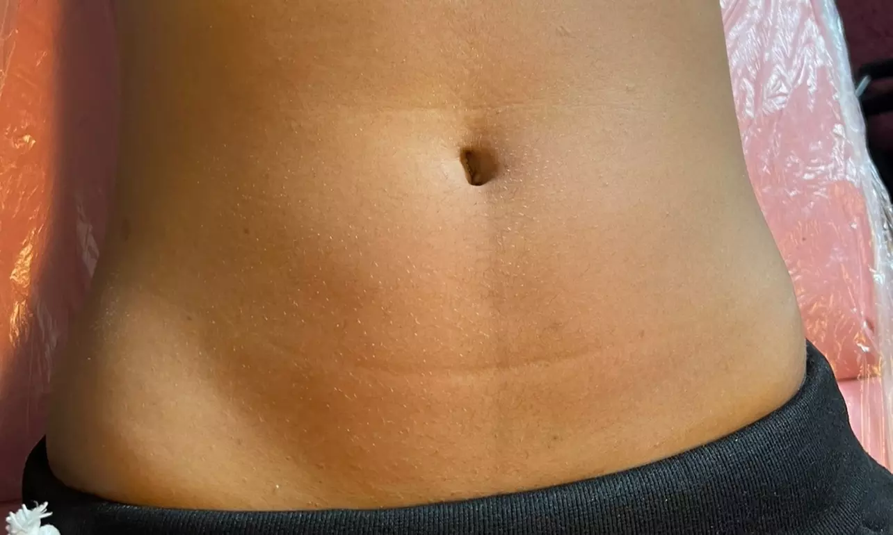 Up to 50% Off on Lipo - Non-Invasive Laser-iLipo at Lashes and Lasers - Primary Image
