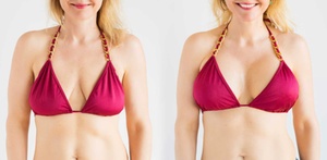 Two, Four, or Six Non-Invasive Breast Lifts at B Fit Body Sculpting