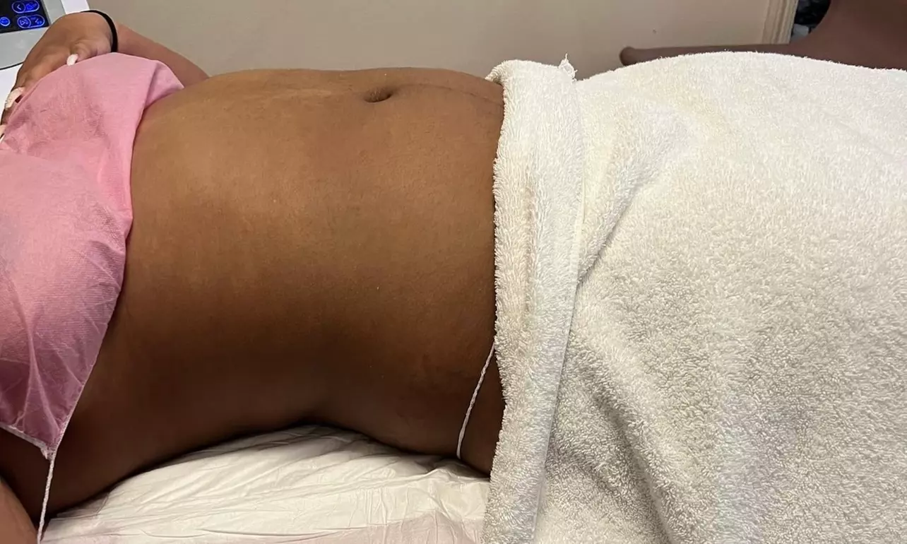 Up to 50% Off on Lipo - Non-Invasive Laser-iLipo at Lashes and Lasers - Second Medium