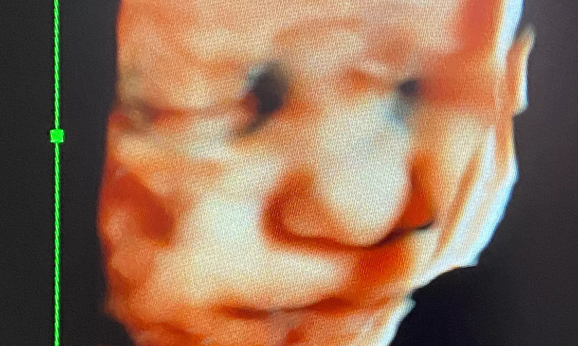 Up to 15% Off on Ultrasound - 3D / 4D at Babys First Impression - Second Medium