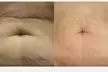 Up to 80% Off on Ultrasonic Fat Reduction at Renew Contouring - Second Medium