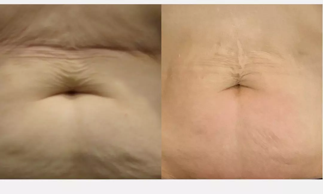 Up to 80% Off on Ultrasonic Fat Reduction at Renew Contouring