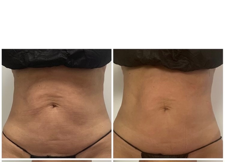 Up to 55% Off Radio Frequency Skin Tightening at LB Glowroom