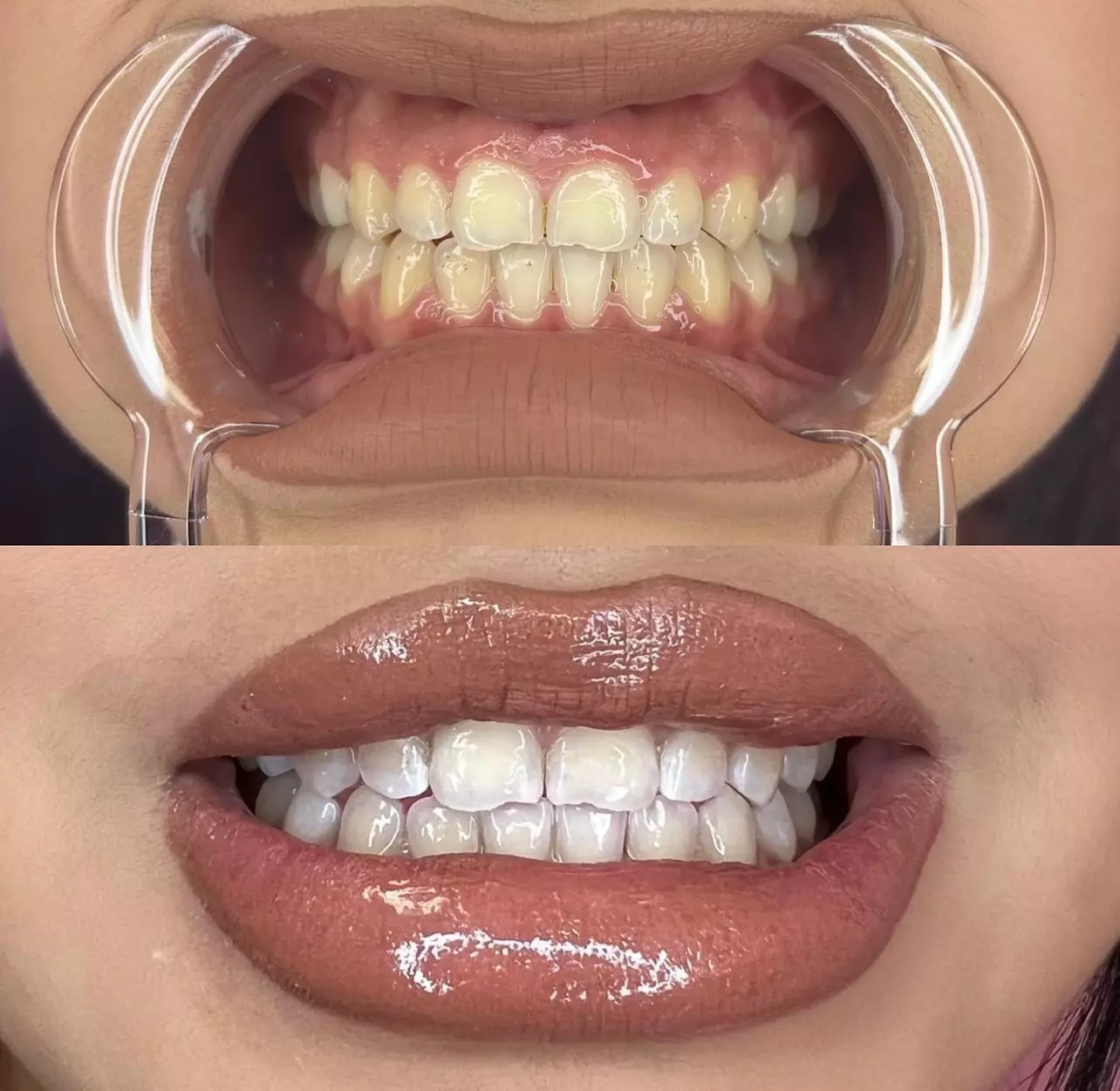 Up to 20% Off on Teeth Whitening at Changes Beaute Lounge - Primary Image