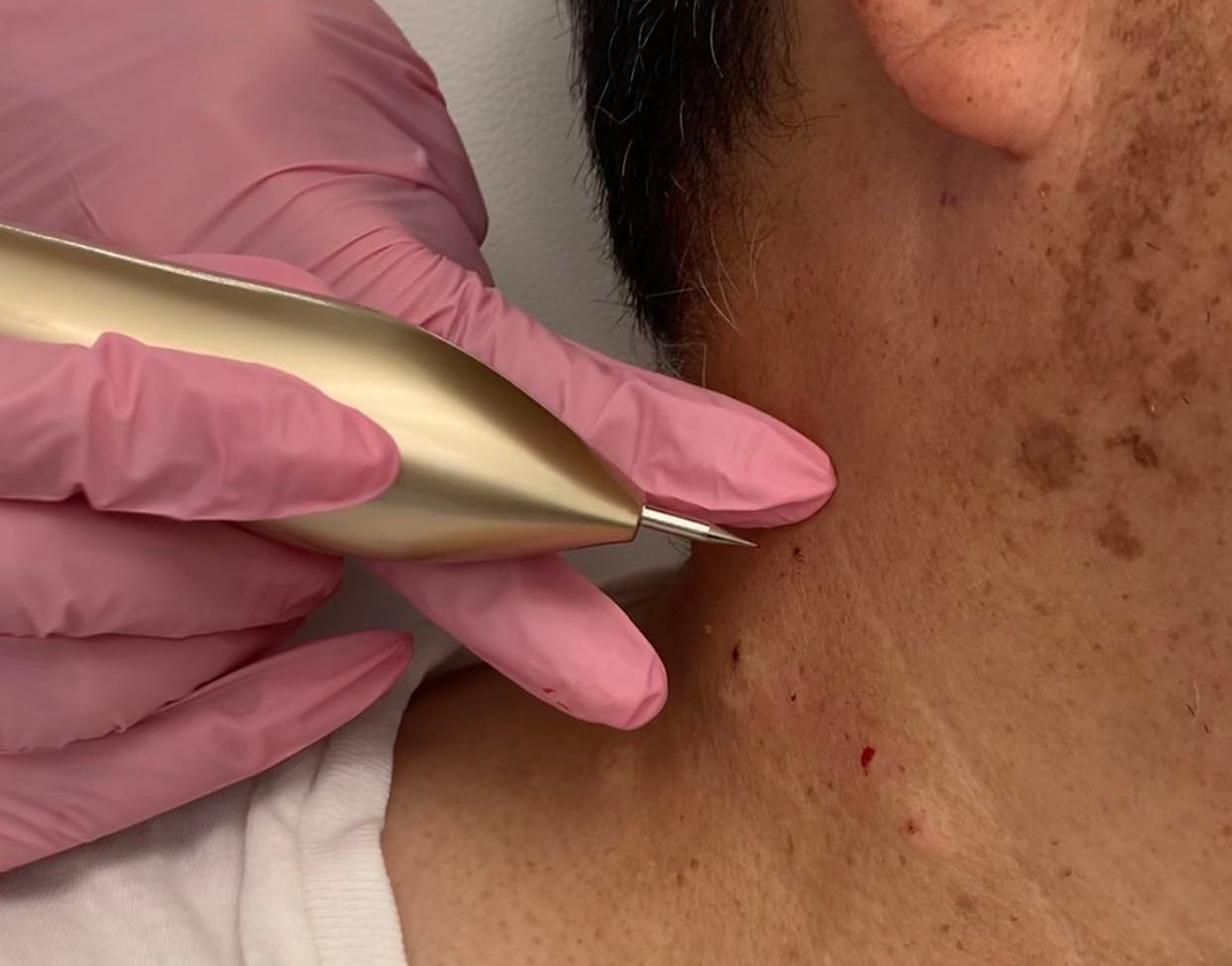 Consultation and Skin Tag Removal Service Options