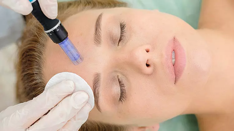 Bis zu 40% Rabatt auf den Micro-Needling bei BeautyBox - Primary Image