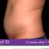 Image 10: Experience Non-Invasive Fat Reduction with TruSculpt