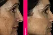 Choose 20, 40, or 60 Units of Xeomin for a Youthful Look at DermAlign Medical Aesthetics(Up To 31% Off) - Second Medium