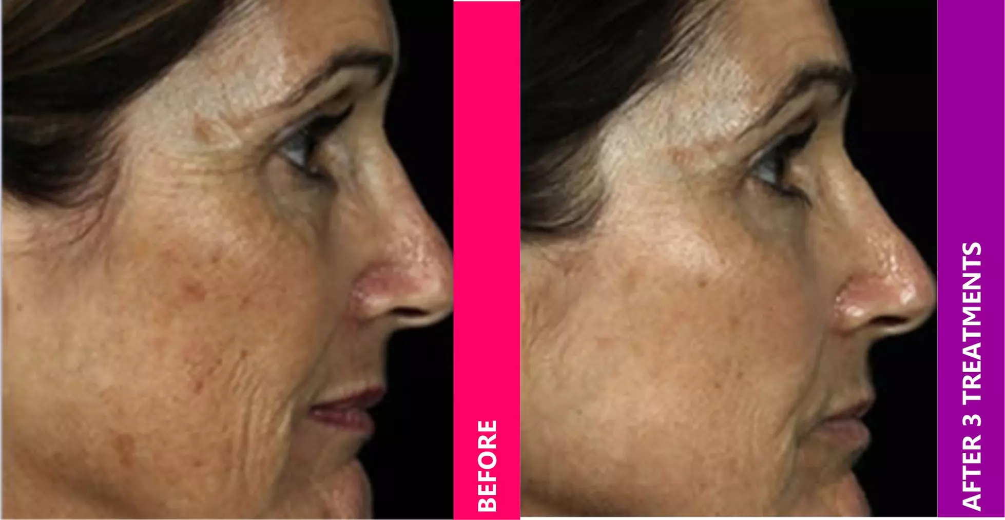 Smooth Wrinkles with 20, 40, or 60 Units of Xeomin