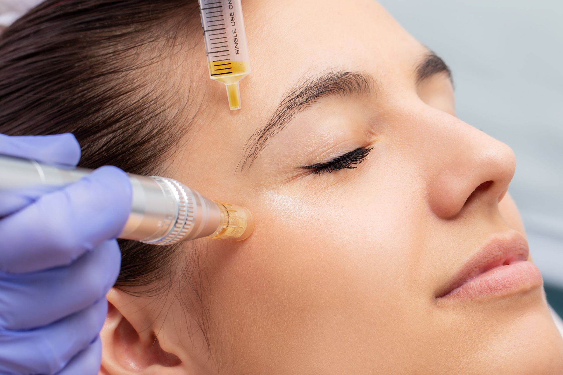 Microneedling with PRP or PRF