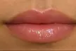 Up to 45% Off on Lip Enhancement at Blaké Aesthetics - Second Medium