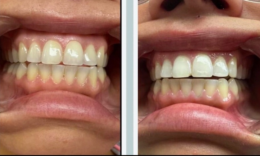 Image 2: Up to 49% Off on Teeth Whitening - In-Office - Non-Branded at Ur Bryte Smile Teeth Whitening