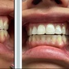 Image 2: Up to 54% Off on Teeth Whitening - In-Office - Non-Branded at Ur Bryte Smile Teeth Whitening