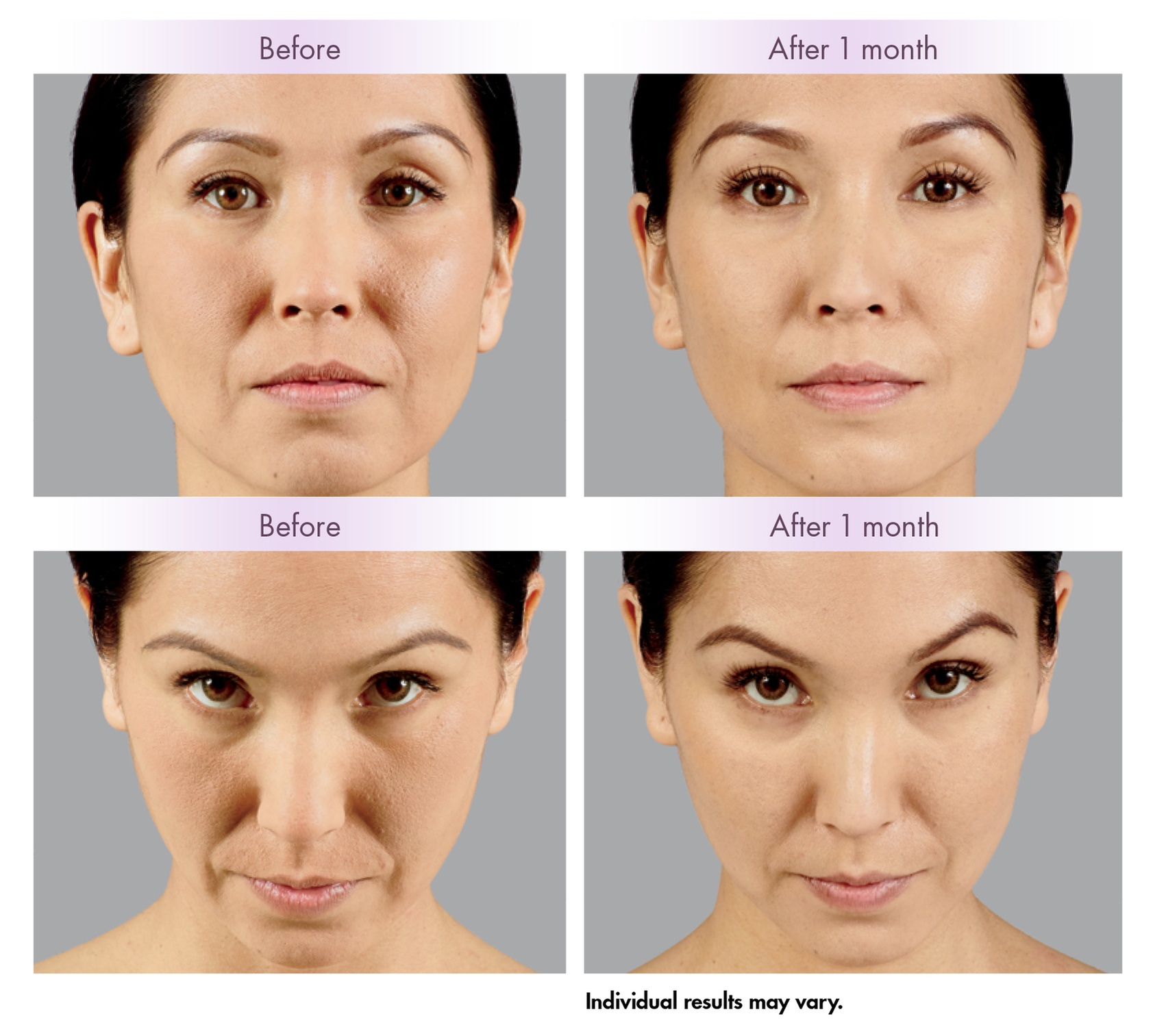 Up to 30% Off on Injection - Voluma at Total Body Aesthetics