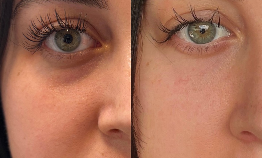 Image 1: Get rejuvenated at Enigma Medi Spa & Laser Center with a PRP Facial including RF Microneedling, offering up to 65% off