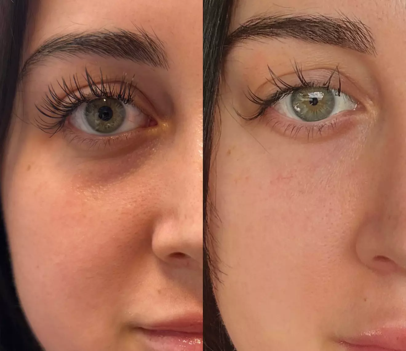 Get rejuvenated at Enigma Medi Spa & Laser Center with a PRP Facial including RF Microneedling, offering up to 65% off
