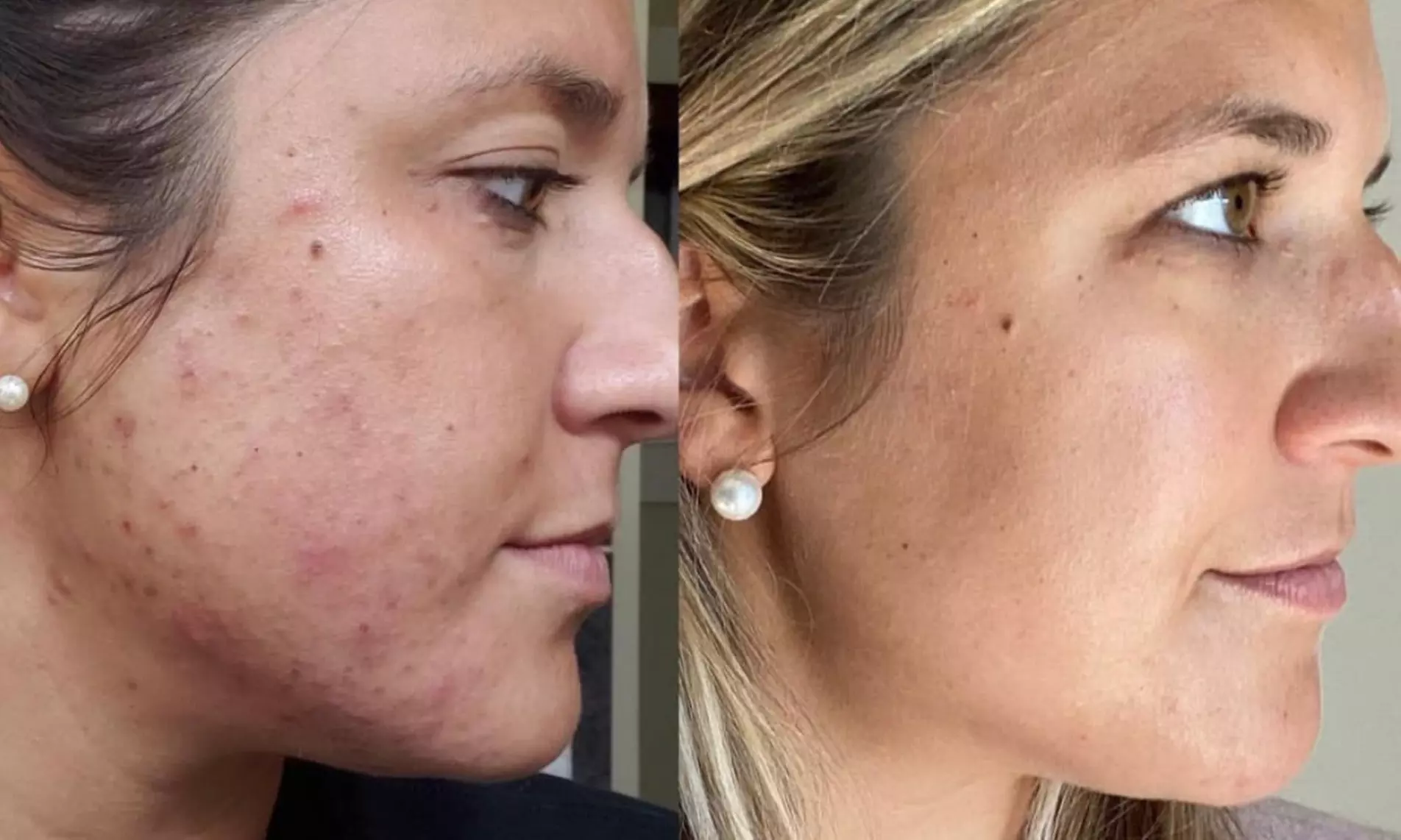 Up to 56% Off on Micro-Needling at Inspire Medical Aesthetics - Primary Image