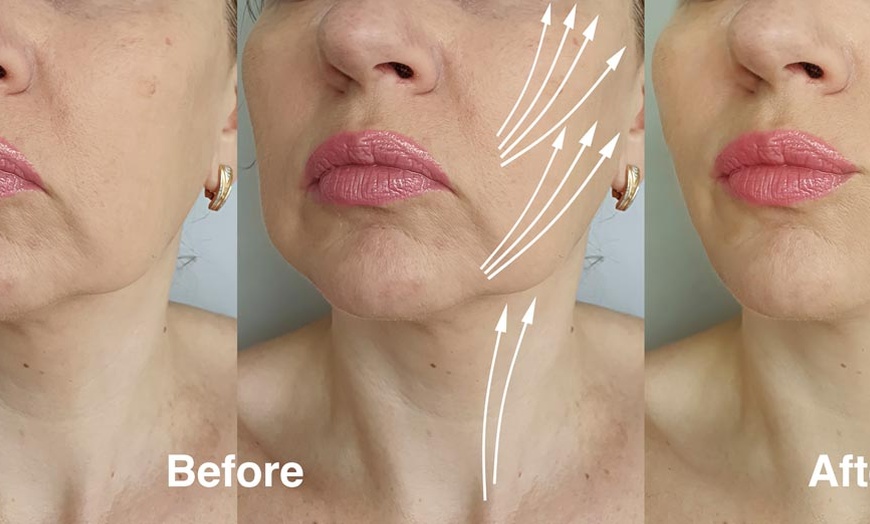 Image 4: Bella Hadid Style Eyebrow Lift With PDO Threads at No Pain All Gain Spa (Up to 30% Off)