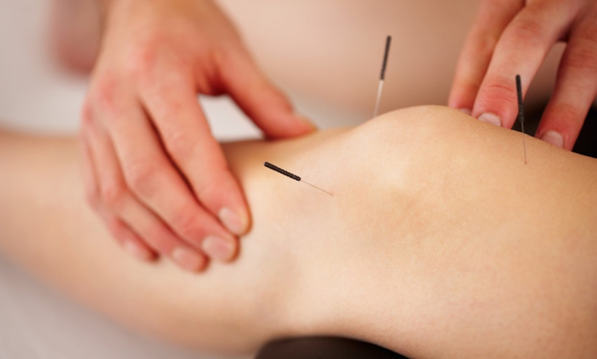 Image 5: Up to 34% Off on Acupuncture Services at United Kingdom