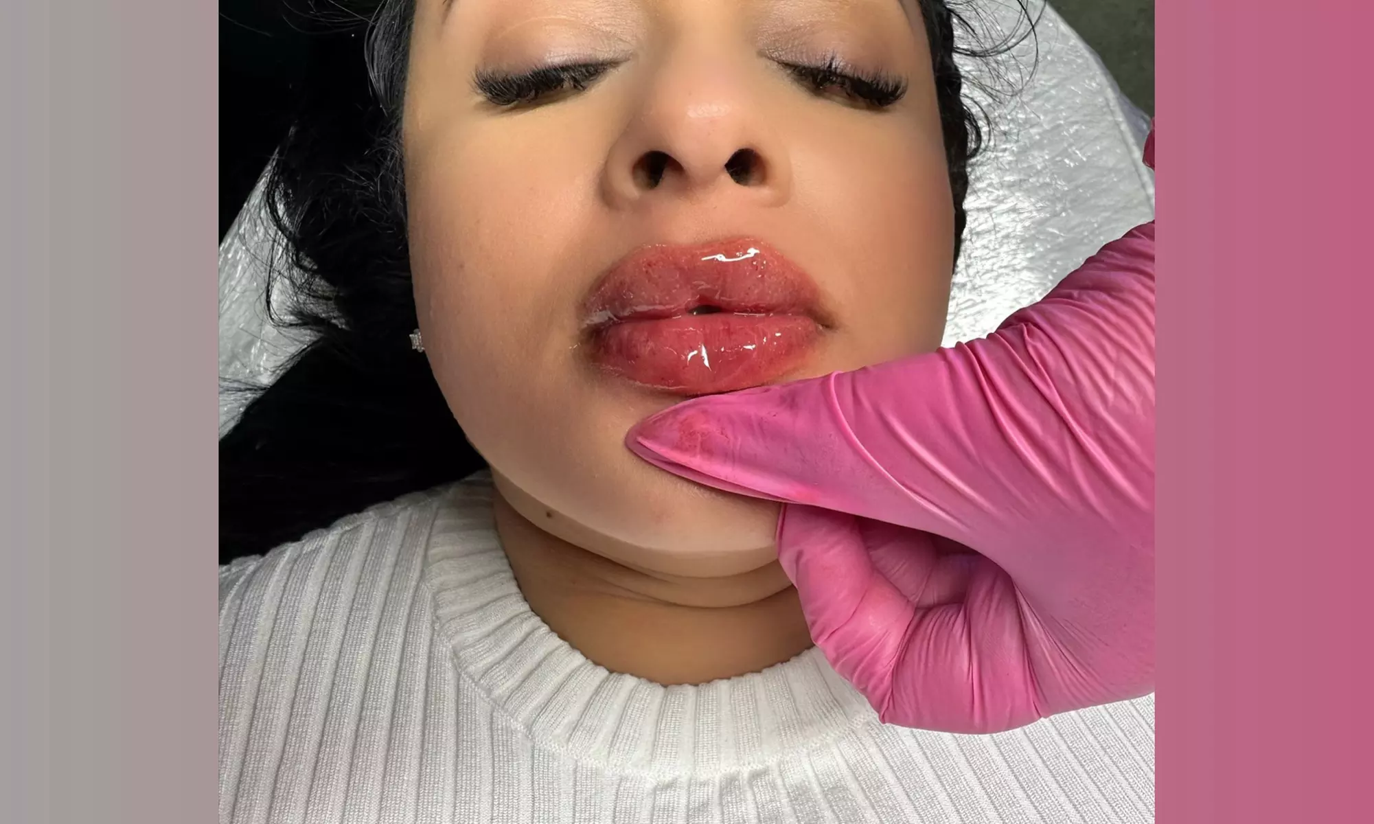 Up to 50% Off on Injection - Hyaluronic Acid at House of Beauty ByJ - Primary Image