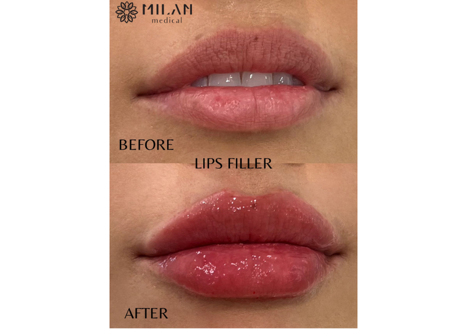 Achieve a Natural Look with Dermal Filler Injections