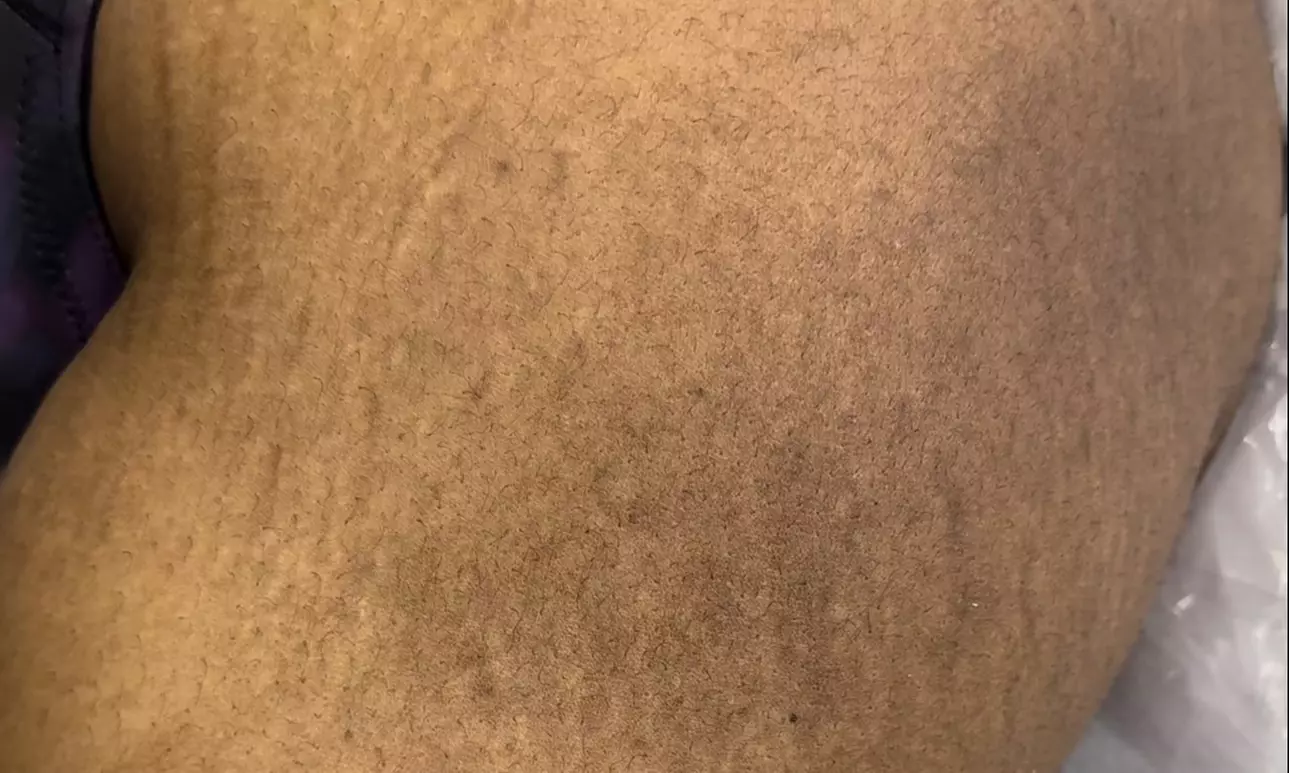 Up to 60% Off on Micro-Needling at Imperfections