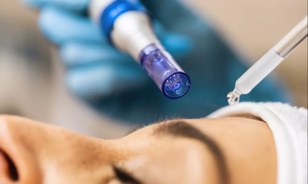 Boost Skin Health with Micro-Needling Sessions