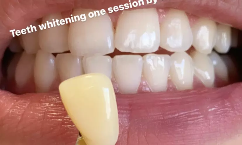 Up to 38% Off on Teeth Whitening - In-Office - Branded (Zoom, Brite Smile) at Zoom Smile - Second Medium