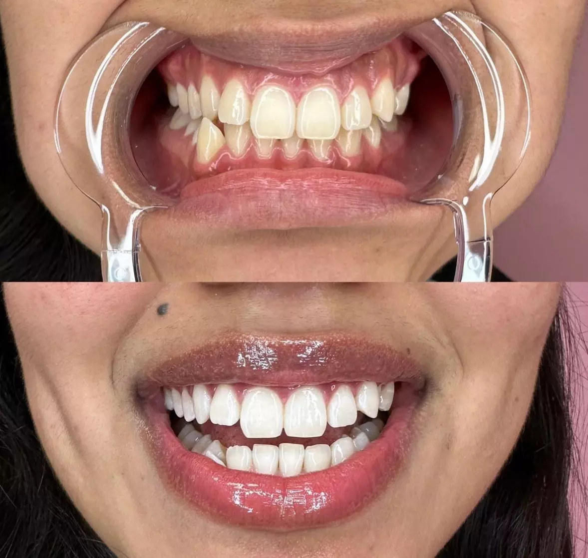 Up to 15% Off on Teeth Whitening at Pearl Glow Smiles - Primary Image