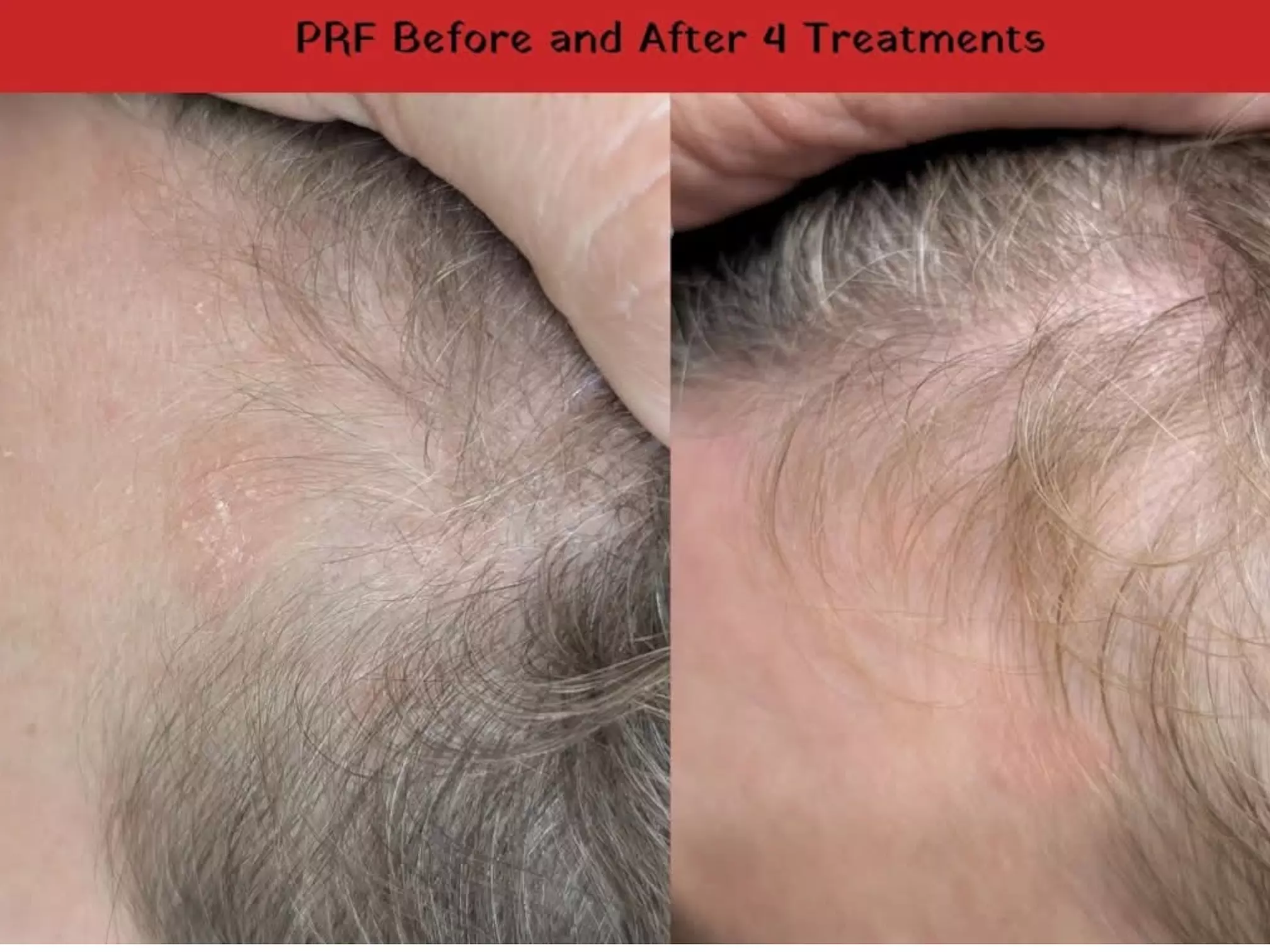 Up to 42% Off on Hair Restoration - Non-Surgical at Gj Skin Clinic - Second Medium