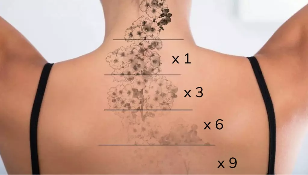 Three laser tattoo removal sessions for medium, mini, or small areas