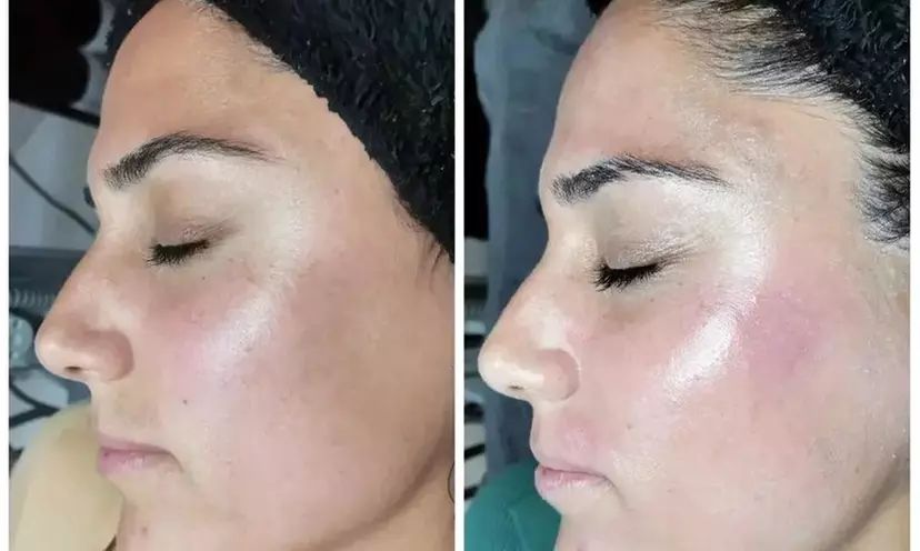 Up to 50% Off on Micro-Needling at Mimosa Spa