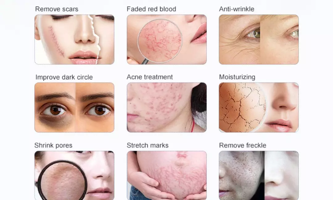 Enhance your skin at Mavii Beauty Lounge with Micro-Needling options, including LED Light Therapy and up to 39% off
