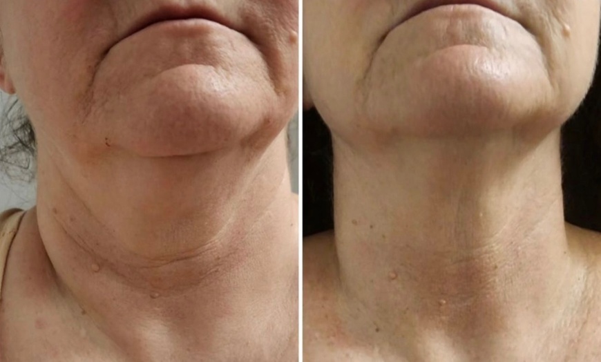 Image 1: Transform your Look with Facial Skin Tightening & Decolletage!