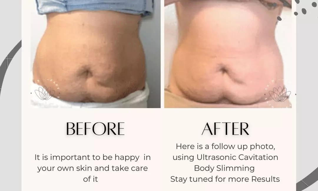 Up to 58% Off on Ultrasonic Fat Reduction at Skin Kneads - Second Medium