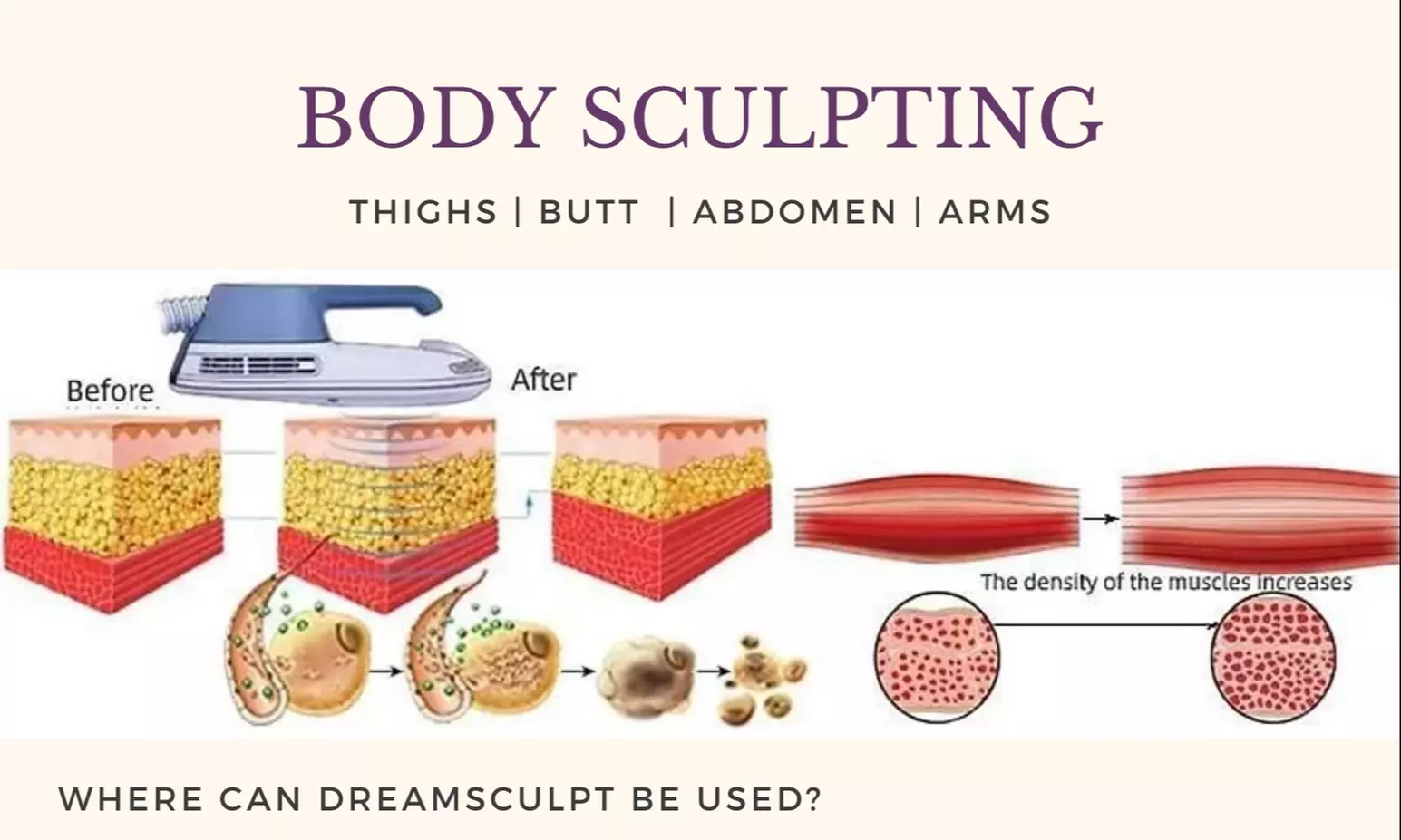 30-Minute Electromagnetic Sculpting: Tone & Shape Muscles Without the Gym(Up To 55% Off) - Second Medium