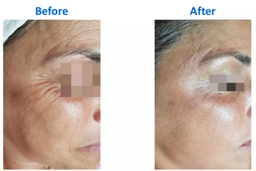 Up to 40% Off on Radio Frequency Skin Tightening