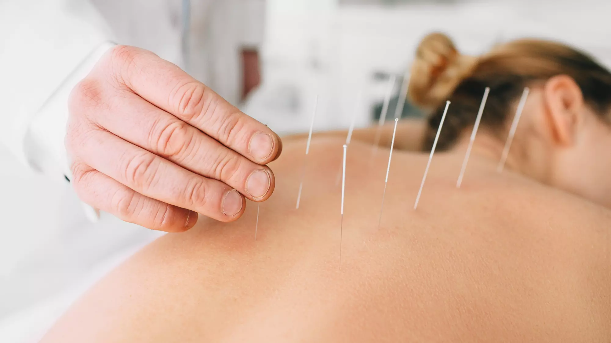 Up to 28% Off on Acupuncture at Acupuncture Xperts - Primary Image