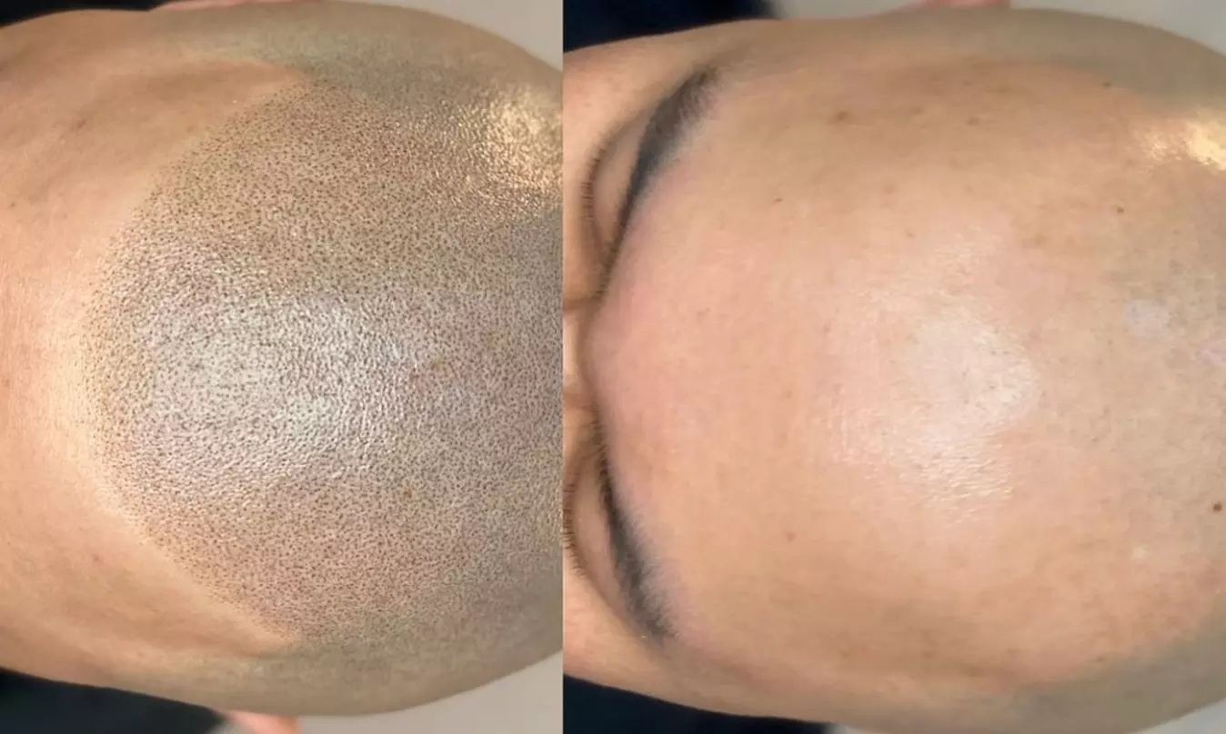 Up to 35% Off on Scalp Micropigmentation at Mink lashes studio by Kary Lee - Primary Image