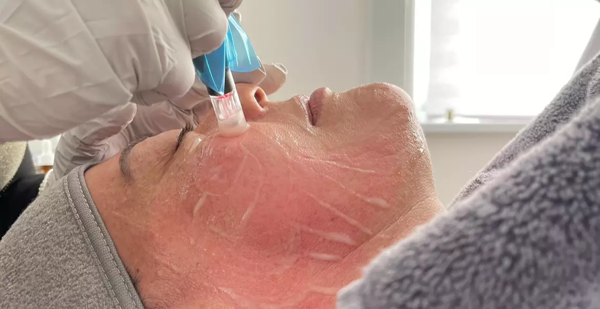 Glow Facial Treatment, Radiofrequency Facial Treatment or Microneedling Facial Treatment (Up to51% Off) - Second Medium