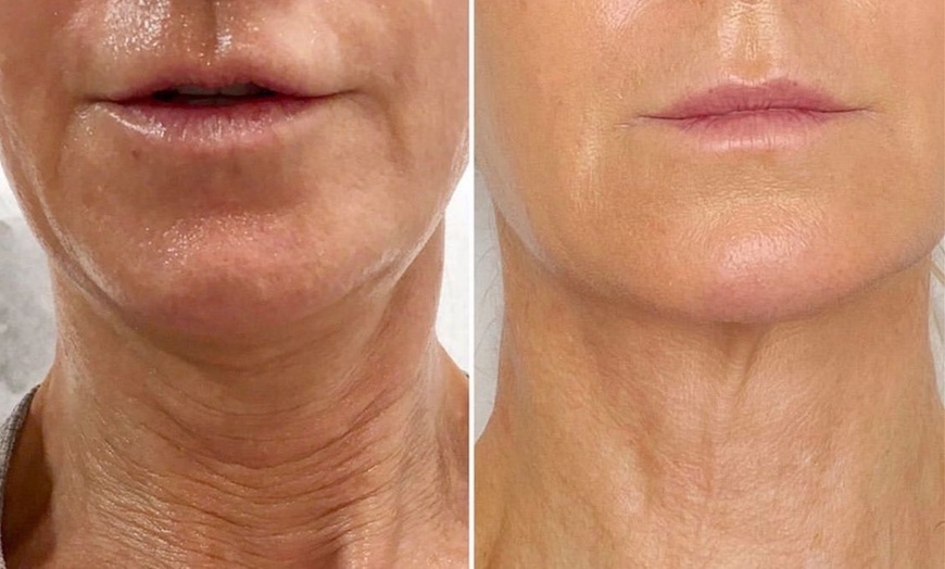 Image 5: Morpheus 8 Face and Neck / Abdomen or Butt Treatment at No Pain All Gain Spa (Up to 37% Off)